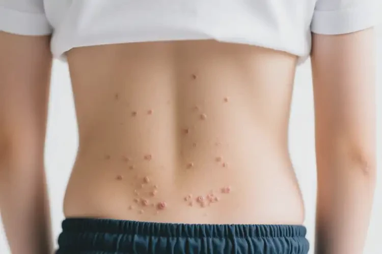 中學(xué)生屁股上偶爾起濕疹能夠徹底治愈嗎(圖4)