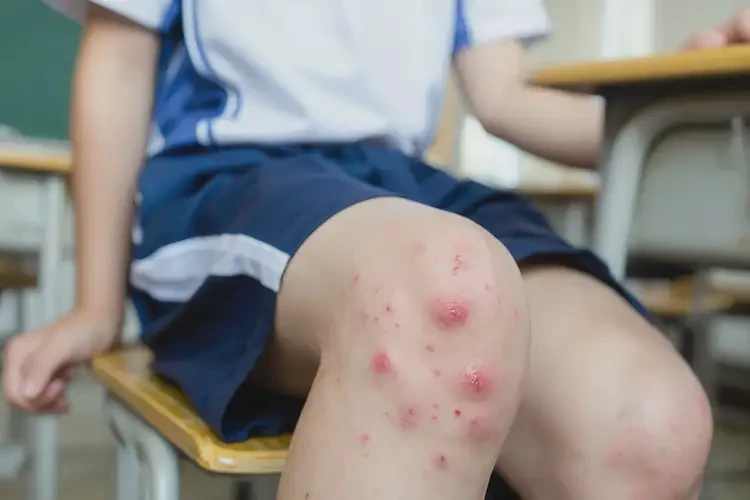 中学生小腿上有湿疹不管它会自己痊愈吗(图4)