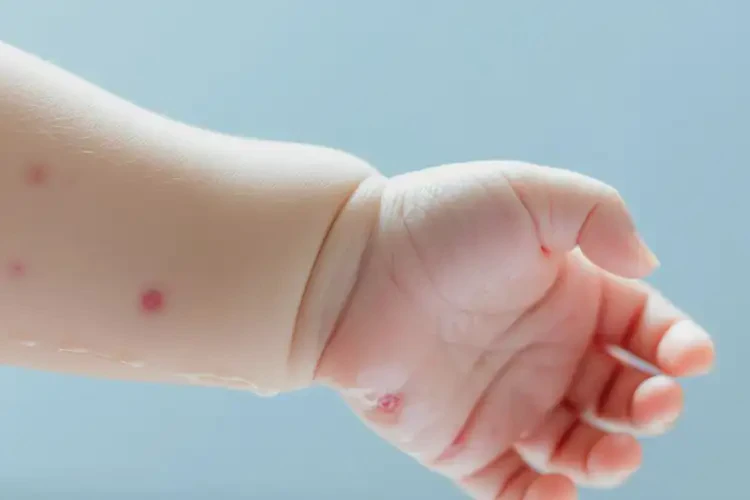 嬰兒手臂上偶爾起濕疹不管它會(huì)自己痊愈嗎(圖1)