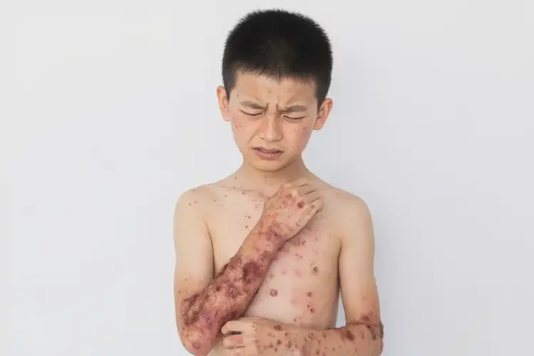 青少年全身出现湿疹能彻底自愈吗(图4)