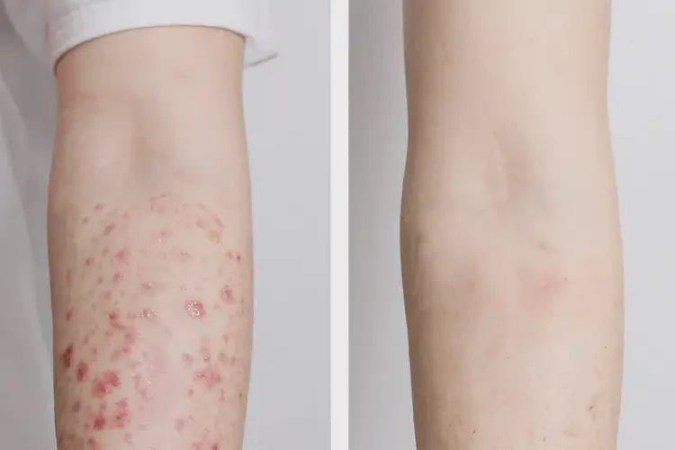 女人手臂長(zhǎng)濕疹能夠徹底治愈嗎(圖2)