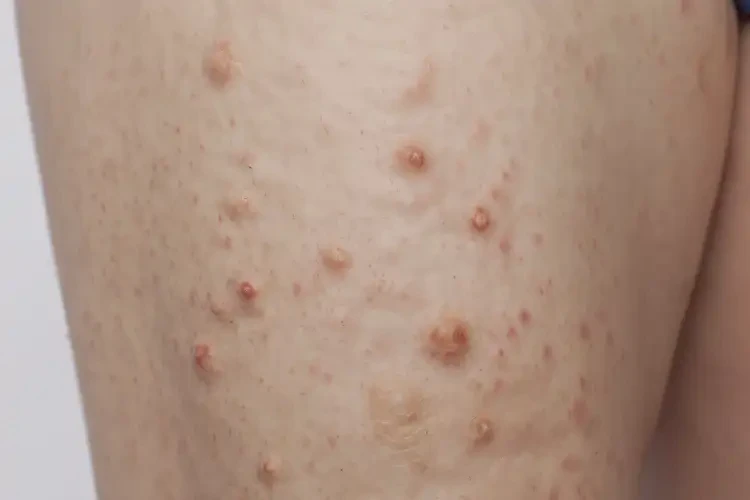 女性四肢有濕疹可不可以徹底自愈(圖4)