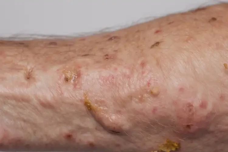 老年人屁股上出現(xiàn)濕疹能夠徹底治愈嗎(圖3)