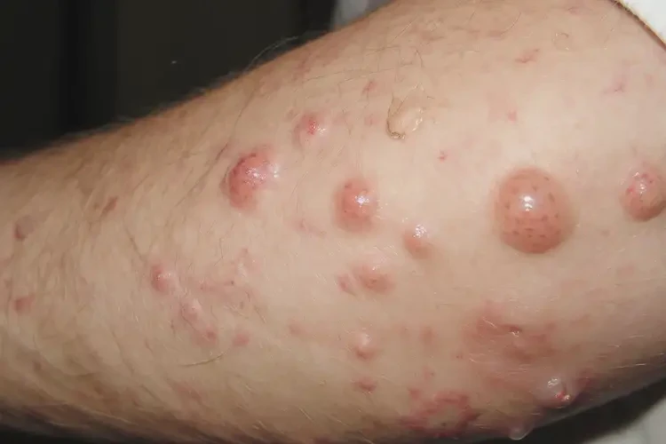 男性屁股偶尔长湿疹不管它会自己痊愈吗(图4)