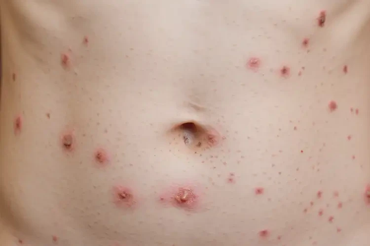 大学生肚子起湿疹不管它会自己自愈吗(图4)