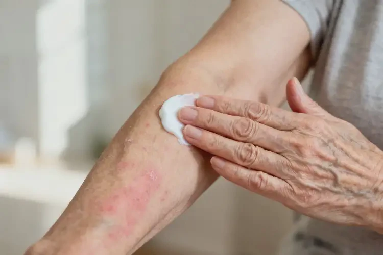 老年人手臂偶爾起濕疹不管它會(huì)自己自愈嗎(圖3)