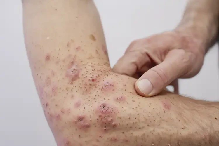 男人身上偶爾長濕疹不管它會自己痊愈嗎(圖4)