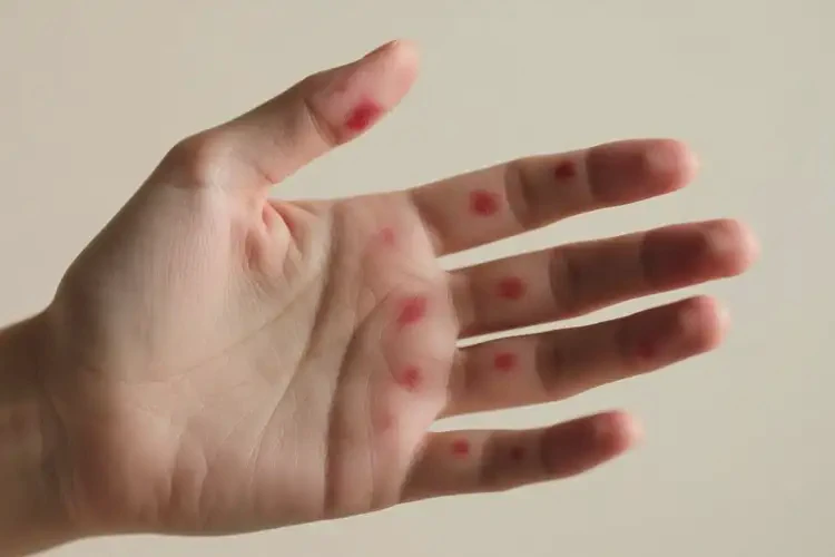 女性手上偶爾起濕疹能靠自己自愈嗎(圖4)