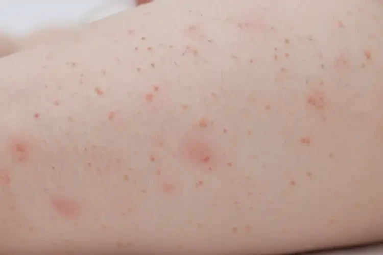 嬰幼兒大腿上偶爾起濕疹不管它會自己痊愈嗎(圖4)