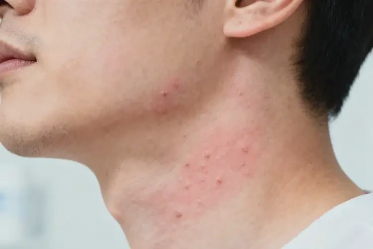 男人脖子上經(jīng)常起濕疹不管它會(huì)自己自愈嗎(圖2)