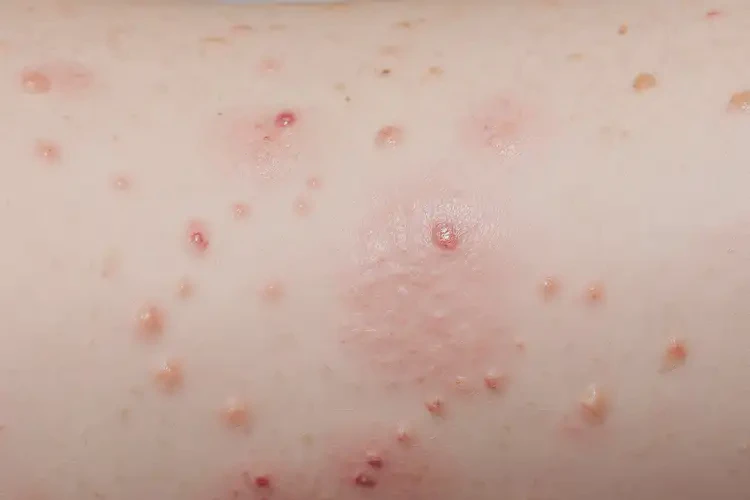 幼儿身上起湿疹能够彻底治愈吗(图4)