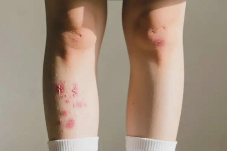 大學(xué)生大腿經(jīng)常長濕疹可以徹底自愈嗎(圖2)