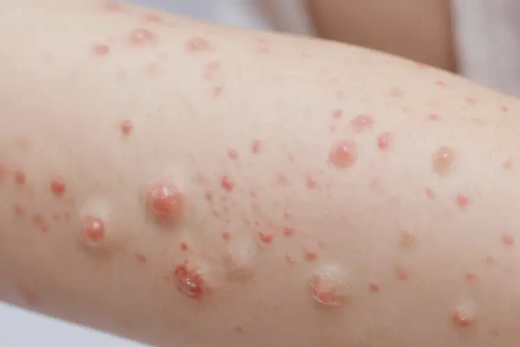 少兒脖子上經(jīng)常起濕疹不管它會(huì)自己痊愈嗎(圖4)