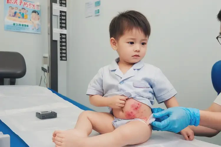 孩子肛周出濕疹不管它會自己好嗎(圖4)