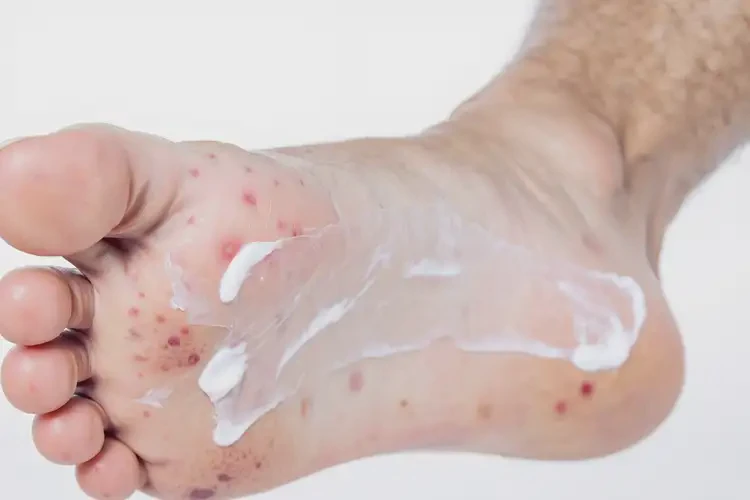 小孩腳上起濕疹不管它會自己好嗎(圖1)