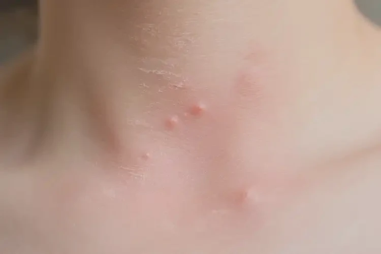 中學(xué)生脖子上長濕疹能徹底自愈嗎(圖3)