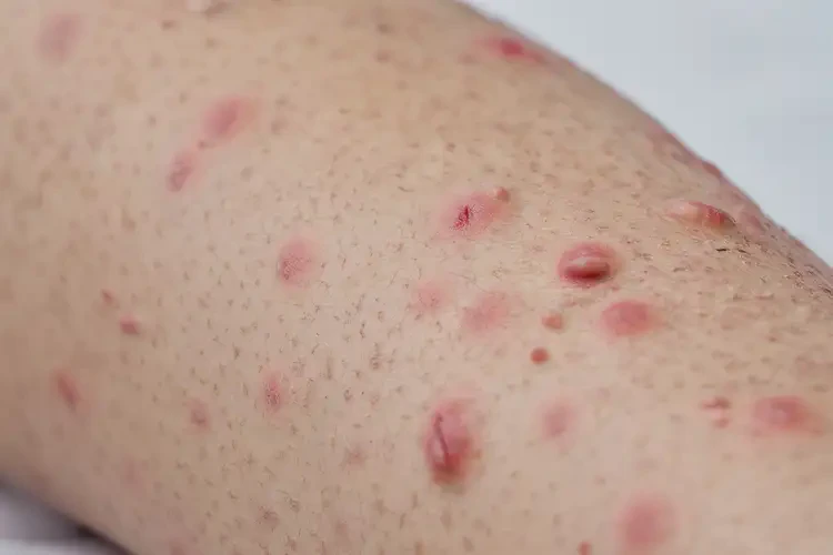 青少年小腿上经常起湿疹能彻底自愈吗(图4)