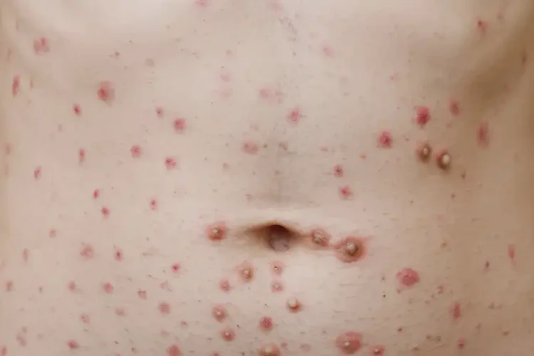 中學(xué)生肚子偶爾起濕疹能夠徹底治愈嗎(圖4)