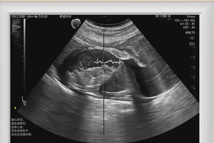 孕17周1天胎心率76寶寶還能要嗎(圖4)