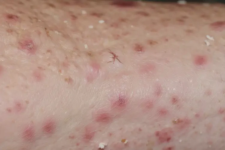 小孩小腿上起濕疹能靠自己自愈嗎(圖2)