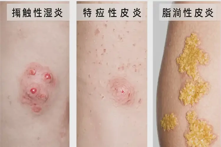 男性大腿容易長濕疹可以徹底自愈嗎(圖2)