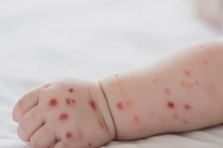 嬰幼兒手臂容易起濕疹不管它會(huì)自己好嗎(圖4)