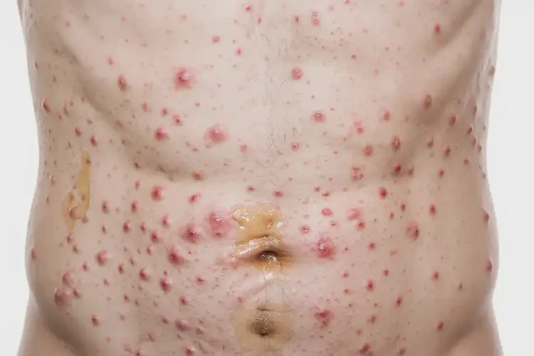 男人肚子上偶爾長(zhǎng)濕疹能徹底自愈嗎(圖3)