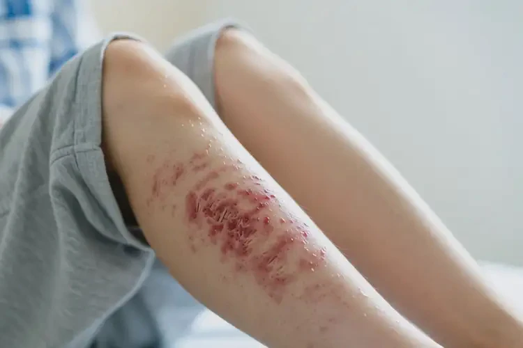 大學(xué)生大腿經(jīng)常長濕疹可以徹底自愈嗎(圖4)