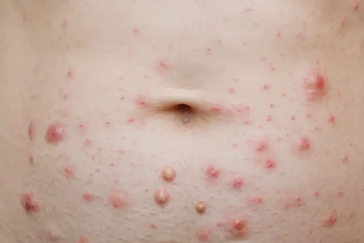 女人肚子上經(jīng)常長(zhǎng)濕疹能不能徹底自愈(圖4)