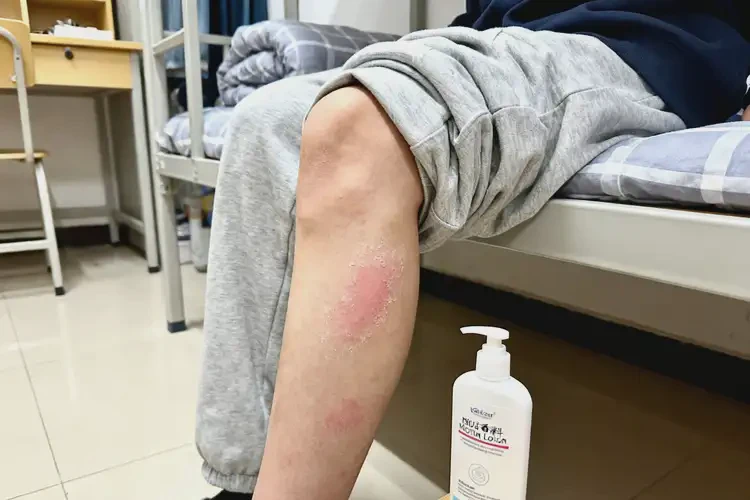 大学生大腿上有湿疹不管它会自己自愈吗(图1)
