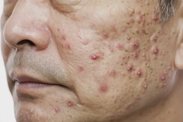 男性屁股有濕疹不管它會(huì)自己痊愈嗎(圖4)