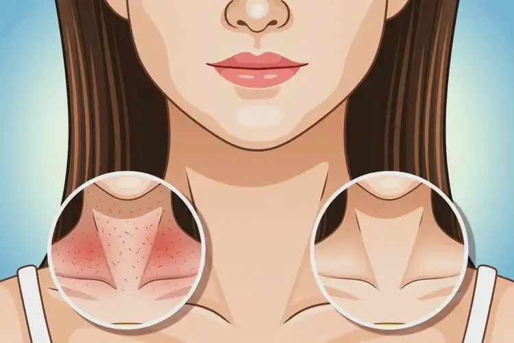 女性脖子長濕疹能靠自己自愈嗎(圖4)