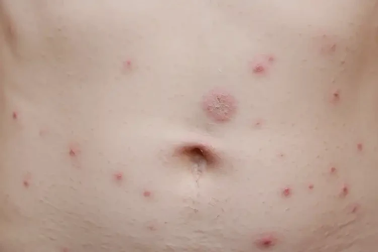 孩子肚子上偶爾長濕疹能夠徹底治愈嗎(圖4)