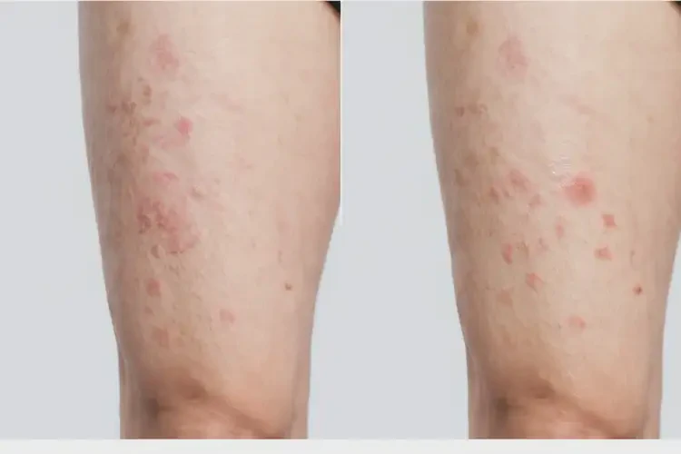 青年人大腿有濕疹不管它會自己好嗎(圖1)