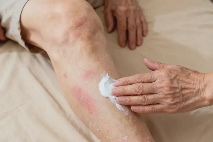 老人大腿上出現(xiàn)濕疹不管它會自己痊愈嗎(圖3)