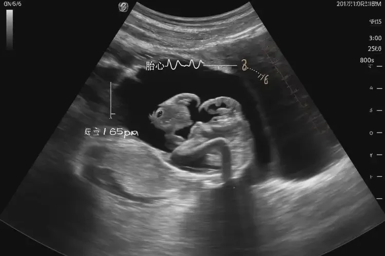 孕8周2天胎心率165怎么回事(圖4)