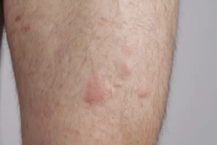 青年人大腿有濕疹不管它會自己好嗎(圖4)