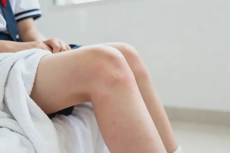 中學(xué)生小腿偶爾長濕疹可不可以徹底自愈(圖3)