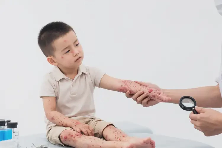 小兒四肢起濕疹能徹底自愈嗎(圖4)