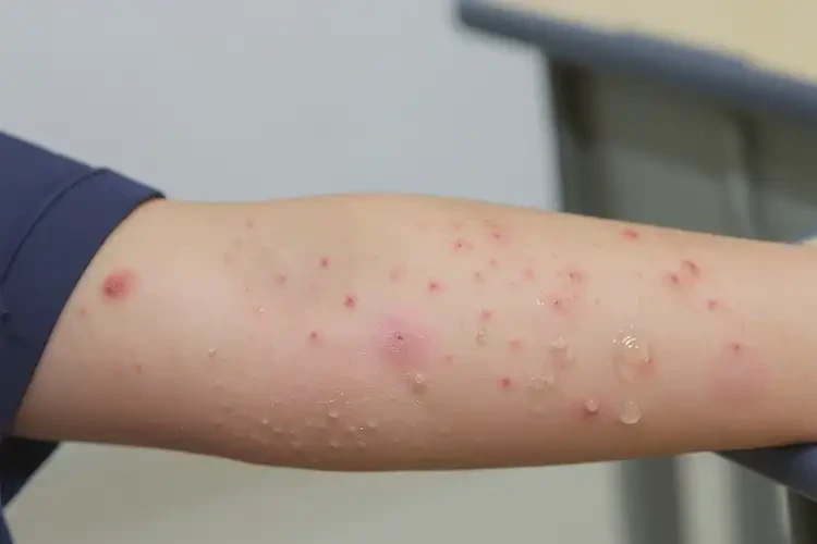 中學(xué)生手臂經(jīng)常起濕疹可以徹底自愈嗎(圖4)