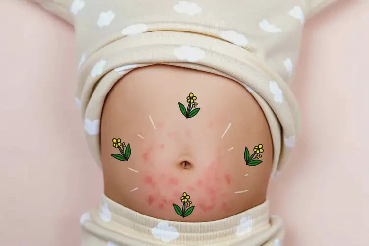 兒童肚子上出濕疹可不可以徹底自愈(圖3)