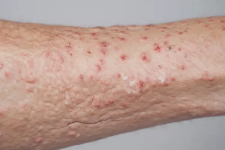 男生四肢起濕疹不管它會(huì)自己自愈嗎(圖3)