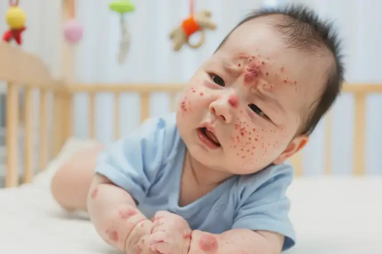 嬰兒全身有濕疹不管它會自己自愈嗎(圖4)