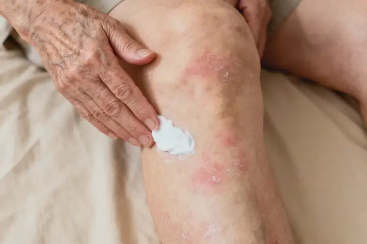 老人大腿上出現(xiàn)濕疹不管它會自己痊愈嗎(圖4)