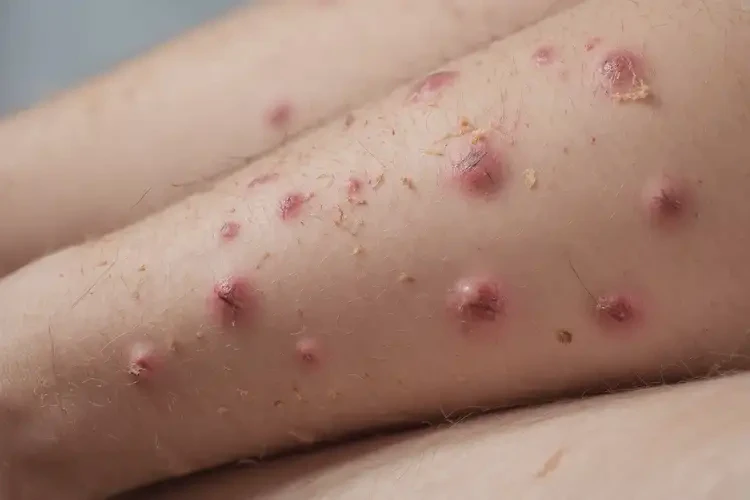 青少年四肢起濕疹能靠自己自愈嗎(圖4)