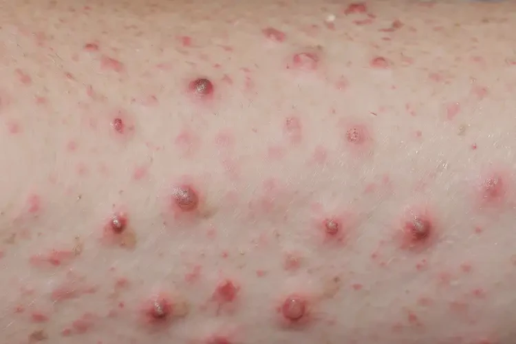 青少年全身出濕疹能徹底自愈嗎(圖4)