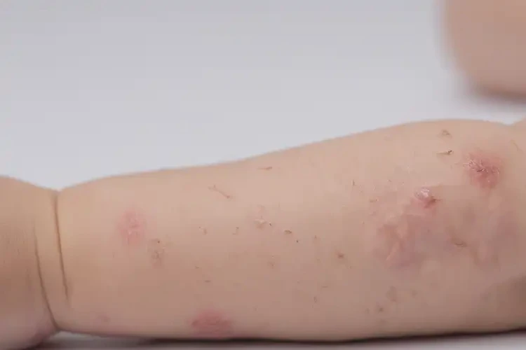 幼兒手臂上起濕疹能夠徹底治愈嗎(圖4)