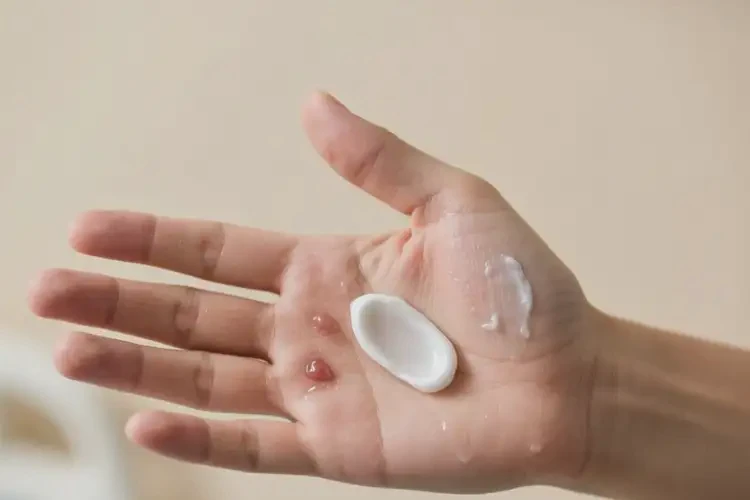 男性手上偶爾起濕疹可不可以徹底自愈(圖4)