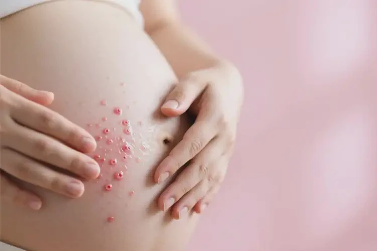 產(chǎn)婦全身長(zhǎng)濕疹能靠自己自愈嗎(圖2)
