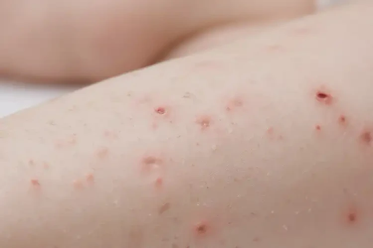 孩子四肢偶爾長濕疹不管它會自己好嗎(圖4)